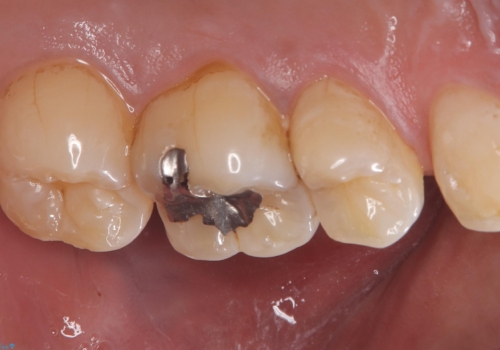 【セラミックインレー】ホワイトニングしに来たら虫歯が見つかったの治療前