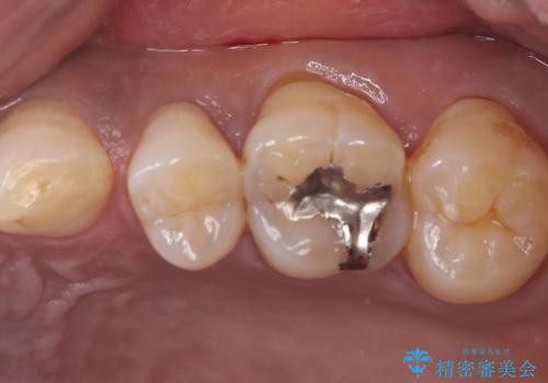 【セラミックインレー】ホワイトニングしに来たら虫歯が見つかったの治療前