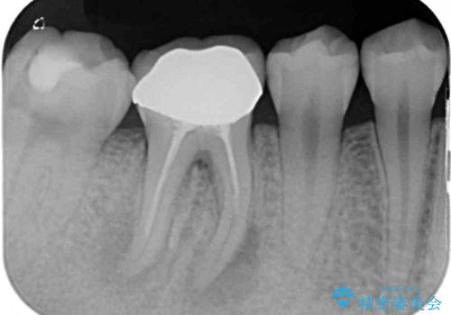 歯茎が腫れている 奥歯の根管治療の治療前
