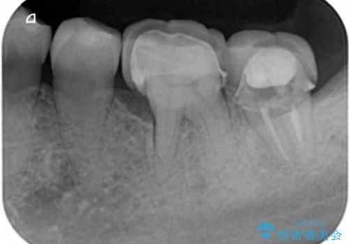 骨よりも深く進行したむし歯 即時荷重インプラントでの短期間治療の治療前