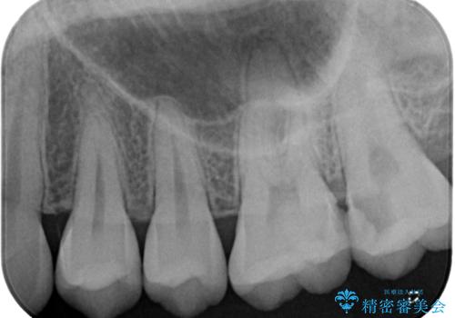 奥歯のむし歯が痛い セラミックによるむし歯治療の治療前