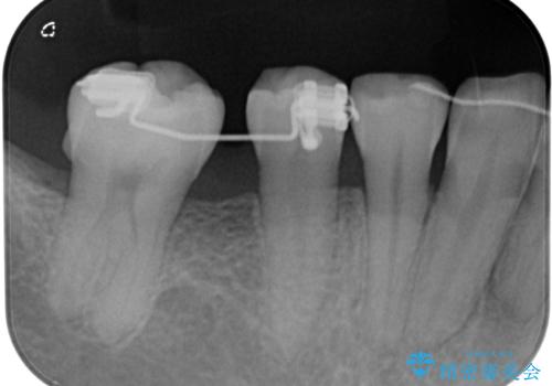 隙間の空いた奥歯 オールセラミッククラウンの補綴治療の治療前