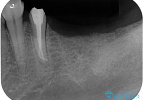 放置していたむし歯 抜歯即時埋入インプラントによる補綴治療の治療前