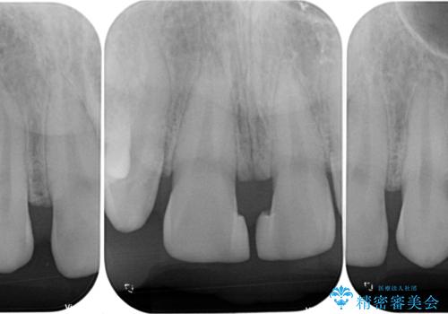 欠損して隙間のある前歯 オールセラミッククラウンで自然な口元にの治療前
