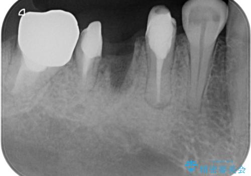 放置していたむし歯 抜歯即時埋入インプラントによる補綴治療の治療前