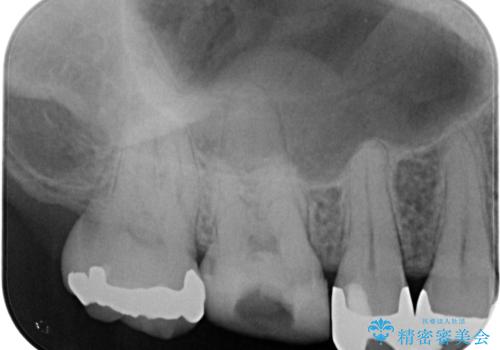 治療途中の奥歯 オールセラミッククラウンでのむし歯治療の治療前