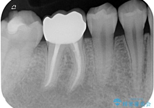 歯茎が腫れている 奥歯の根管治療の治療後