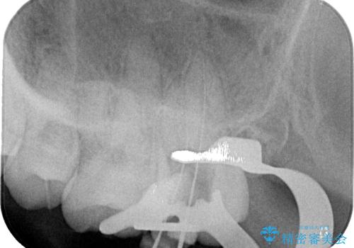 奥歯のむし歯が痛い セラミックによるむし歯治療の治療中