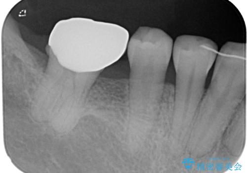 隙間の空いた奥歯 オールセラミッククラウンの補綴治療の治療後