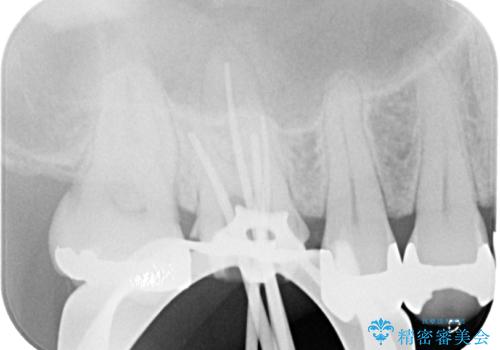 治療途中の奥歯 オールセラミッククラウンでのむし歯治療の治療中