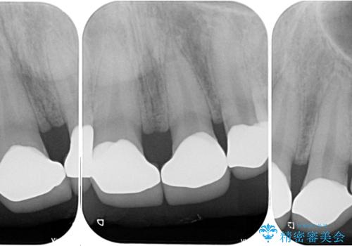 欠損して隙間のある前歯 オールセラミッククラウンで自然な口元にの治療後