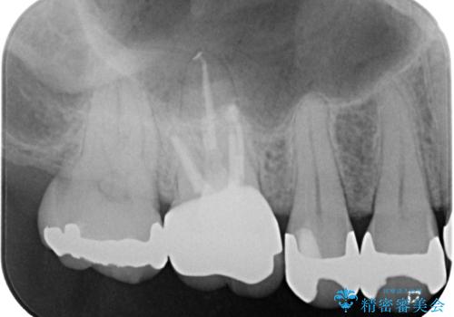 治療途中の奥歯 オールセラミッククラウンでのむし歯治療の治療後