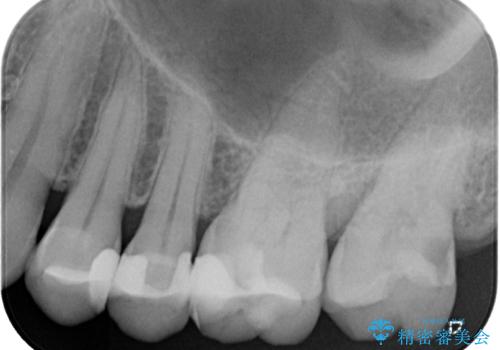 冷たいものがしみる ゴールドを用いた奥歯のむし歯治療の治療前