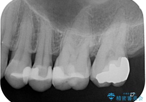 冷たいものがしみる ゴールドを用いた奥歯のむし歯治療の治療後