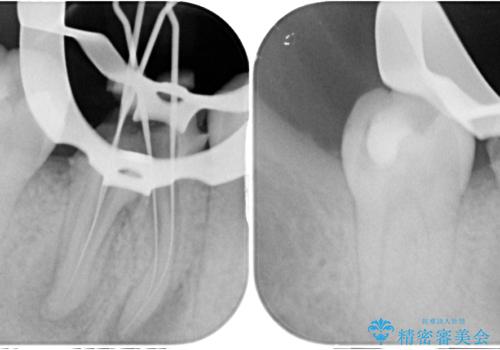 歯茎が腫れている 奥歯の根管治療の治療中