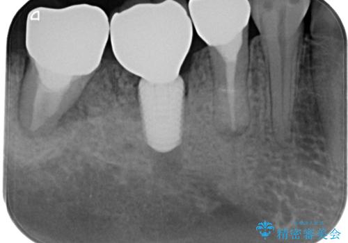 放置していたむし歯 抜歯即時埋入インプラントによる補綴治療の治療後