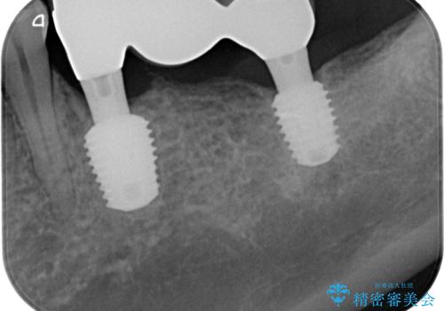 放置していたむし歯 抜歯即時埋入インプラントによる補綴治療の治療後