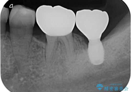 骨よりも深く進行したむし歯 即時荷重インプラントでの短期間治療の治療後