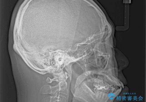 口が閉じられない 抜歯矯正で前歯の突出感を改善の治療前