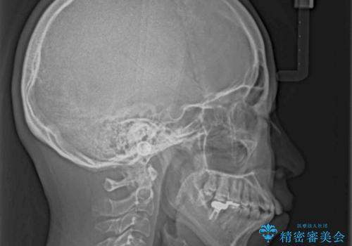 【モニター】口が閉じられない ワイヤー装置での抜歯矯正の治療前