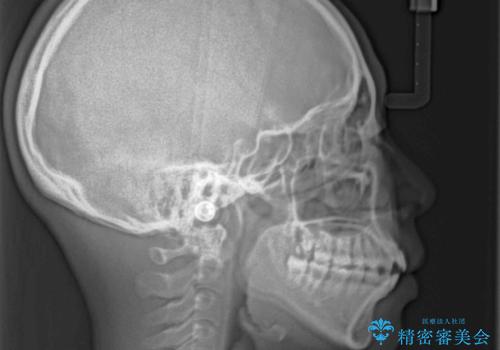 【モニター】舌突出癖で隙間が　ワイヤー装置での抜歯矯正の治療前