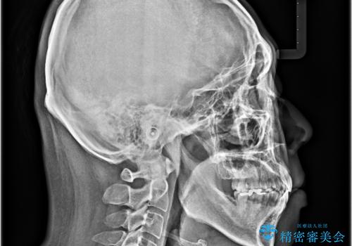 口が閉じられない 抜歯矯正で前歯の突出感を改善の治療後