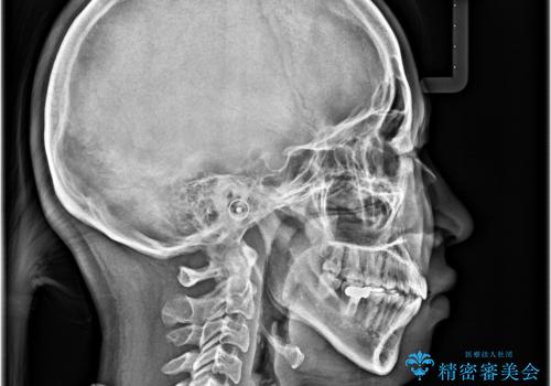 【モニター】口が閉じられない ワイヤー装置での抜歯矯正の治療後