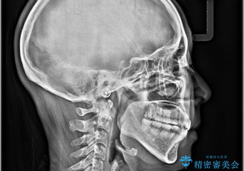 【モニター】舌突出癖で隙間が ワイヤー装置での抜歯矯正の治療後