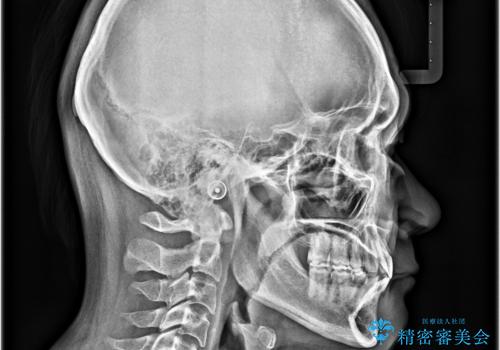 飛び出した前歯を治したい　ワイヤー装置での抜歯矯正の治療後