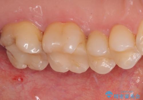 冷たいものがしみる ゴールドを用いた奥歯のむし歯治療の治療前