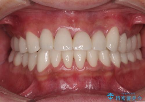 受け口傾向の咬み合わせを治したい 全顎セラミック治療の症例 治療後