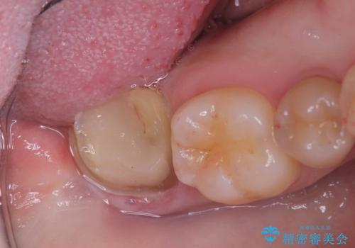 神経を残す治療|VPT|生活歯髄療法|オールセラミッククラウン|神経を残しながらクロスバイトの改善!の治療中