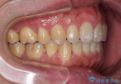 口が閉じられない 抜歯矯正で前歯の突出感を改善の治療後