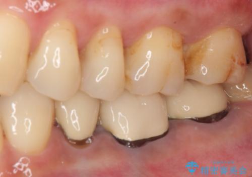 冷たいものがしみる ゴールドを用いた奥歯のむし歯治療の治療前
