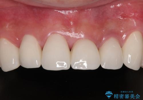 受け口傾向の咬み合わせを治したい 全顎セラミック治療の治療後