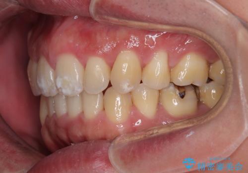 口が閉じられない 抜歯矯正で前歯の突出感を改善の治療後