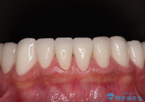 受け口傾向の咬み合わせを治したい 全顎セラミック治療の治療後