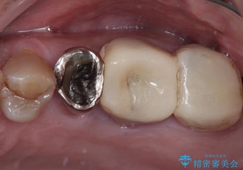 インプラント治療を含む精密審美治療の症例 治療前