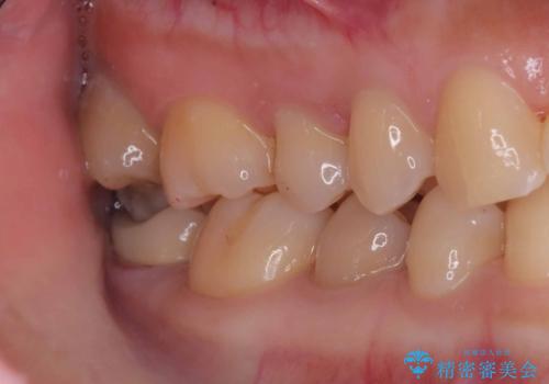 神経を残す治療|VPT|生活歯髄療法|オールセラミッククラウン|神経を残しながらクロスバイトの改善!の治療後