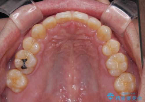 口が閉じられない 抜歯矯正で前歯の突出感を改善の治療後