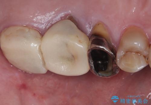 インプラント治療を含む精密審美治療の治療前