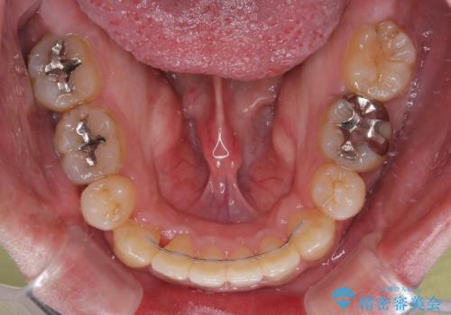 口が閉じられない 抜歯矯正で前歯の突出感を改善の治療後