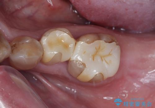 インプラント治療を含む精密審美治療の治療前