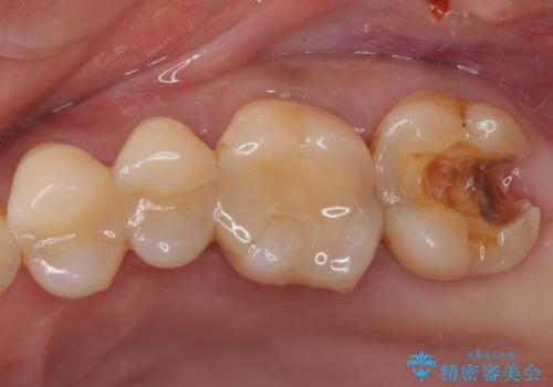 冷たいものがしみる ゴールドを用いた奥歯のむし歯治療の治療中