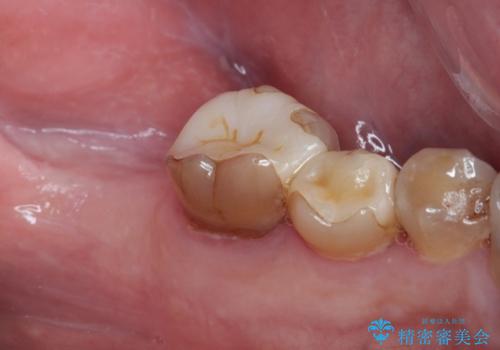 インプラント治療を含む精密審美治療の治療前