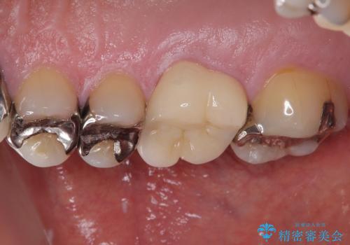 治療途中の奥歯 オールセラミッククラウンでのむし歯治療の治療後
