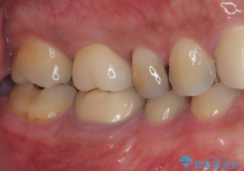治療途中の奥歯 オールセラミッククラウンでのむし歯治療の治療後