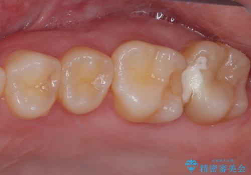 奥歯のむし歯が痛い セラミックによるむし歯治療