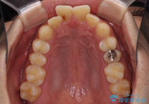 飛び出した前歯を治したい　ワイヤー装置での抜歯矯正の治療前