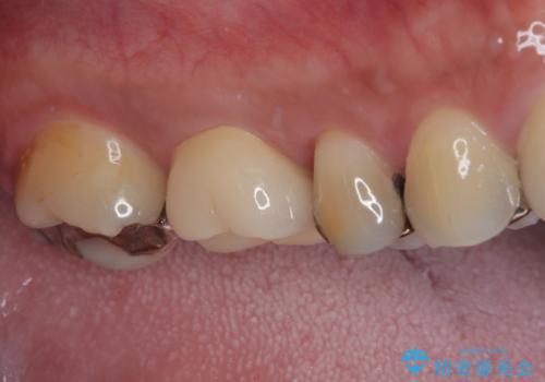 治療途中の奥歯 オールセラミッククラウンでのむし歯治療の治療後
